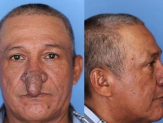 El hombre con una extraña enfermedad en la nariz al que le devolvieron la alegría