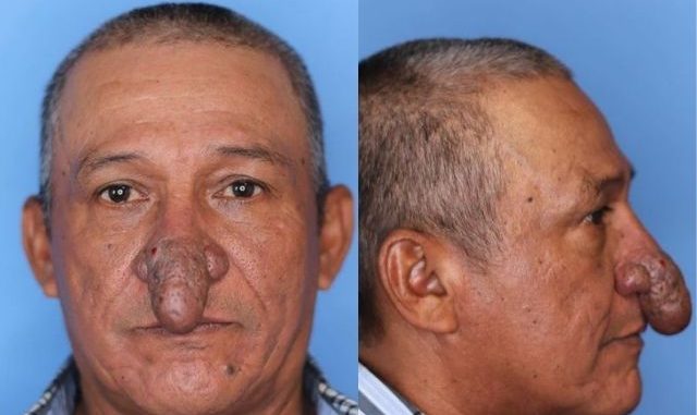 El hombre con una extraña enfermedad en la nariz al que le devolvieron la alegría