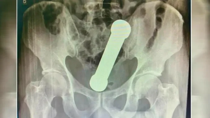 Radiografia-de-hombre-con-mancuerna