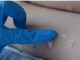 viruela del mono