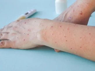 Viruela-del-mono-o-simica-en-Medellin
