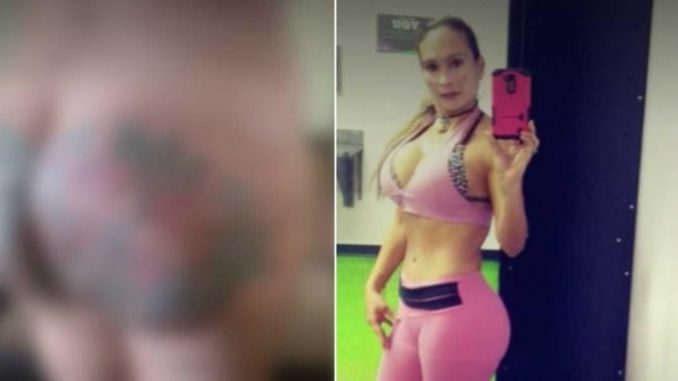 La mujer ahora se enfrenta a perder sus glúteos, aunque los profesionales luchan por salvarlos