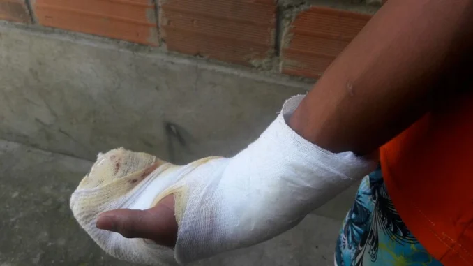niños quemados con pólvora