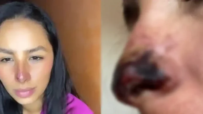 Se-puso-acido-hialuronico-en-la-nariz-y-casi-la-pierde-678x381