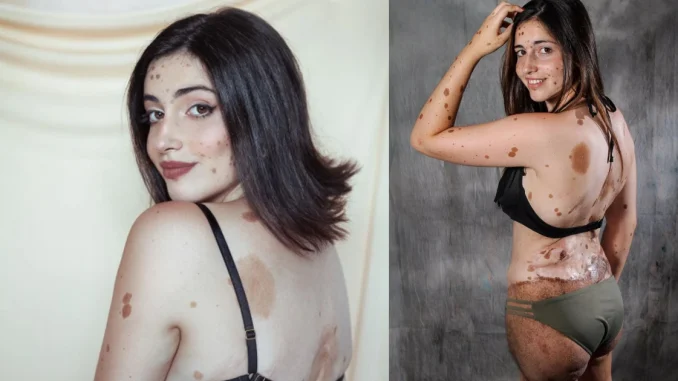 Lunares, Alba Parejo, española, viral, redes sociales, reinado, belleza, mujer real, lunares, mundo, internacional, noticias virales, Q’Hubo Medellín, Q’Hubo de hoy